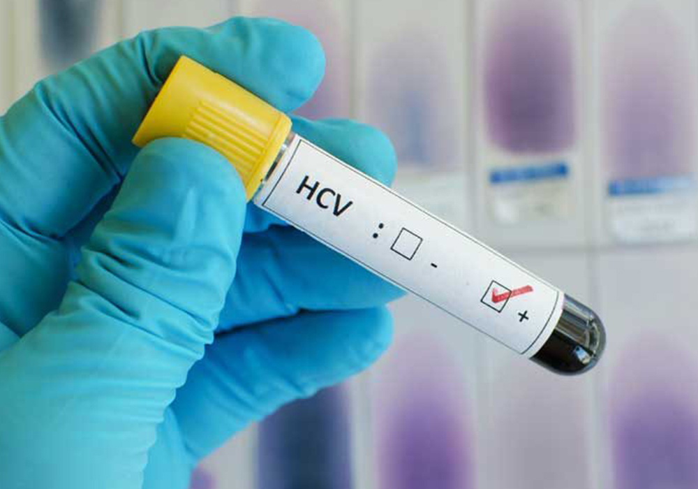 A medical professional wearing gloves is holding a vile with the label indicating an HCV positive result.